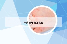 牛皮癣干皮怎么办