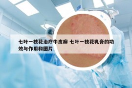 七叶一枝花治疗牛皮癣 七叶一枝花乳膏的功效与作用和图片