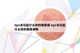 hpv会引起什么样的银屑病 hpv会引起什么样的银屑病呢