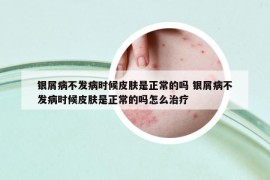 银屑病不发病时候皮肤是正常的吗 银屑病不发病时候皮肤是正常的吗怎么治疗