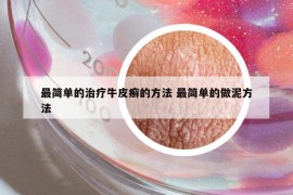 最简单的治疗牛皮癣的方法 最简单的做泥方法