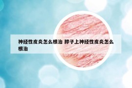 神经性皮炎怎么根治 脖子上神经性皮炎怎么根治