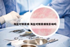 海盐对银屑病 海盐对银屑病有影响吗