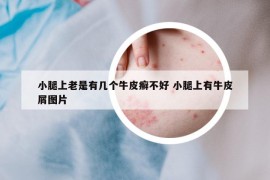 小腿上老是有几个牛皮癣不好 小腿上有牛皮屑图片