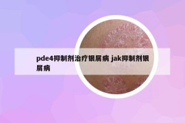 pde4抑制剂治疗银屑病 jak抑制剂银屑病