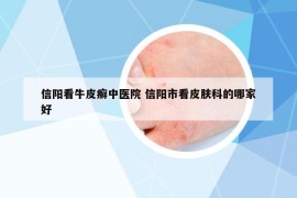 信阳看牛皮癣中医院 信阳市看皮肤科的哪家好