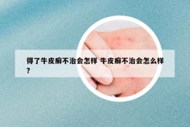 得了牛皮癣不治会怎样 牛皮癣不治会怎么样?