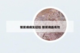银屑病病友经验 银屑病最有效