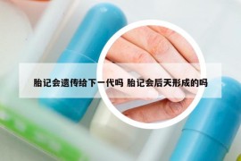 胎记会遗传给下一代吗 胎记会后天形成的吗