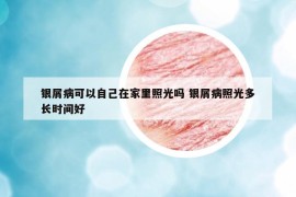 银屑病可以自己在家里照光吗 银屑病照光多长时间好