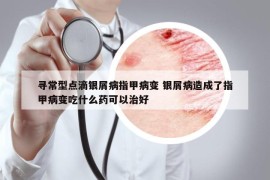 寻常型点滴银屑病指甲病变 银屑病造成了指甲病变吃什么药可以治好