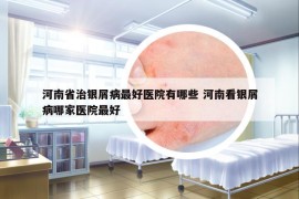 河南省治银屑病最好医院有哪些 河南看银屑病哪家医院最好