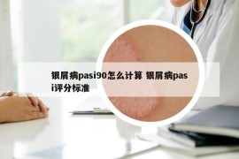 银屑病pasi90怎么计算 银屑病pasi评分标准