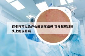 百多邦可以治疗头部银屑病吗 百多邦可以擦头上的皮藓吗