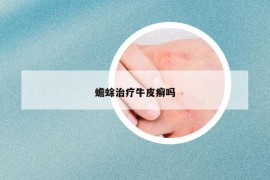 蟾蜍治疗牛皮癣吗