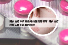 国内治疗牛皮癣最好的医院是哪家 国内治疗股骨头坏死最好的医院