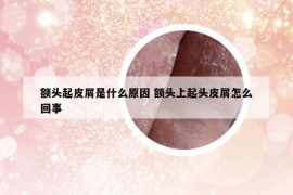 额头起皮屑是什么原因 额头上起头皮屑怎么回事
