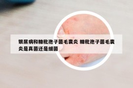 银屑病和糠秕孢子菌毛囊炎 糠秕孢子菌毛囊炎是真菌还是细菌