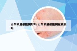 山东银屑病医院好吗 山东银屑病医院花钱贵吗