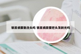 银屑病要勤洗头吗 银屑病需要把头发剃光吗