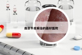 南京牛皮癣治的最好医院