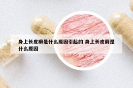 身上长皮癣是什么原因引起的 身上长皮藓是什么原因