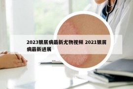2023银屑病最新尤物视频 2021银屑病最新进展