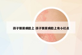 孩子银屑病脸上 孩子银屑病脸上有小红点
