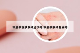 银屑病皮肤发红还很疼 银屑病发红有点疼