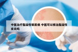 中医治疗脂溢性银屑病 中医可以根治脂溢性皮炎吗