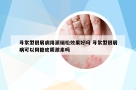 寻常型银屑病用派瑞松效果好吗 寻常型银屑病可以用糖皮质激素吗