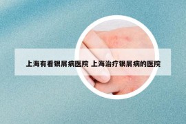 上海有看银屑病医院 上海治疗银屑病的医院