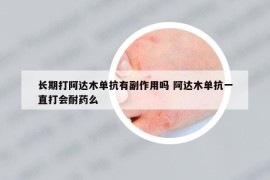长期打阿达木单抗有副作用吗 阿达木单抗一直打会耐药么
