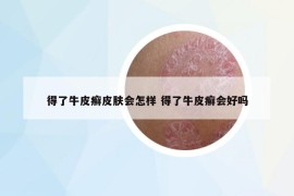 得了牛皮癣皮肤会怎样 得了牛皮癣会好吗