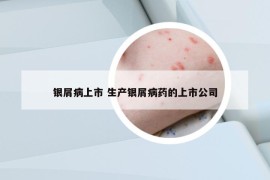 银屑病上市 生产银屑病药的上市公司