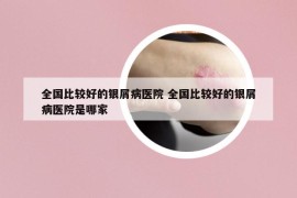 全国比较好的银屑病医院 全国比较好的银屑病医院是哪家