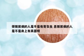 得银屑病的人是不是有寄生虫 患银屑病的人是不是身上有真菌呀