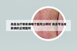 南昌治疗银屑病哪个医院口碑好 南昌专治皮肤病的正规医院