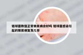 链球菌数值正常银屑病会好吗 链球菌感染引起的银屑病复发几率