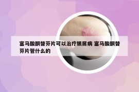富马酸酮替芬片可以治疗银屑病 富马酸酮替芬片管什么的