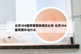 北京304医院看银屑病怎么样 北京304医院擅长治什么