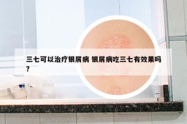 三七可以治疗银屑病 银屑病吃三七有效果吗?