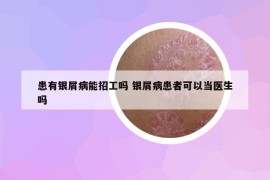 患有银屑病能招工吗 银屑病患者可以当医生吗