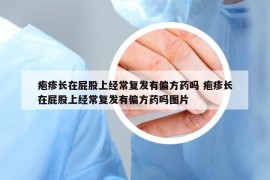 疱疹长在屁股上经常复发有偏方药吗 疱疹长在屁股上经常复发有偏方药吗图片