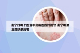 南宁找哪个医治牛皮癣医院好的快 南宁哪里治皮肤病厉害