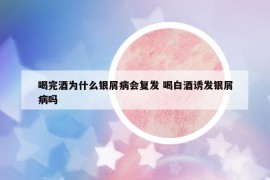 喝完酒为什么银屑病会复发 喝白酒诱发银屑病吗
