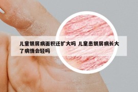 儿童银屑病面积还扩大吗 儿童患银屑病长大了病情会轻吗