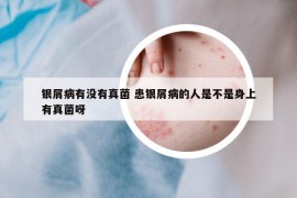银屑病有没有真菌 患银屑病的人是不是身上有真菌呀