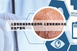 儿童银屑病多数是遗传吗 儿童银屑病长大后会变严重吗
