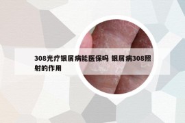 308光疗银屑病能医保吗 银屑病308照射的作用